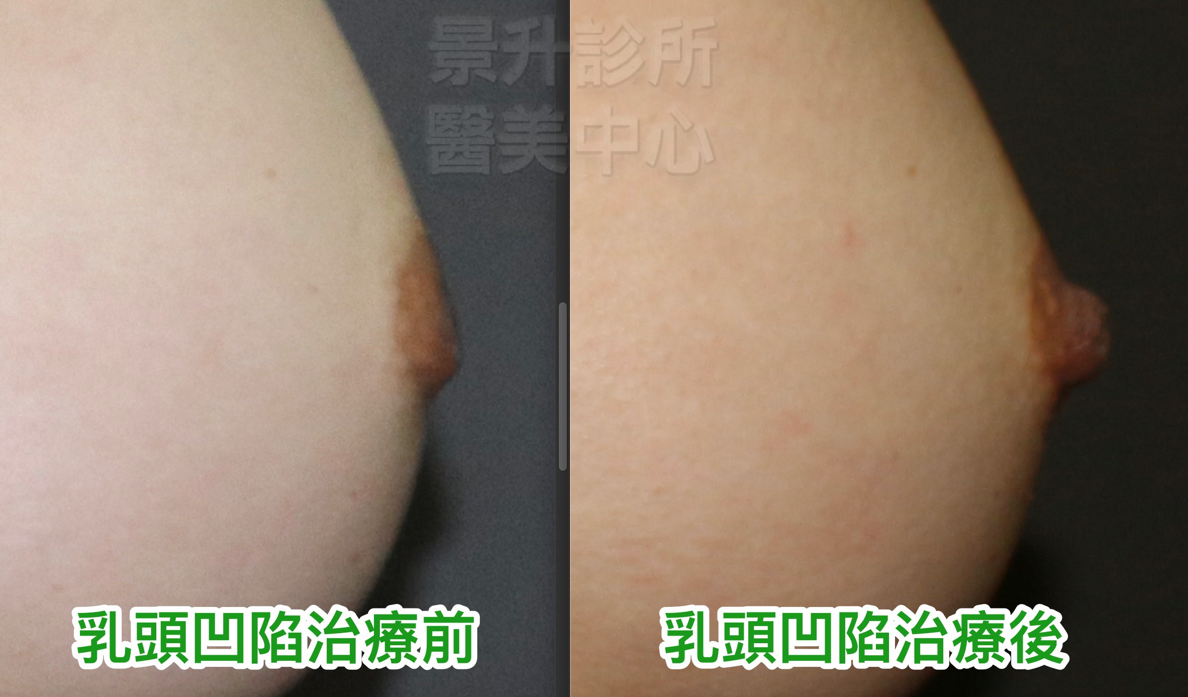 乳頭凹陷治療前後圖2