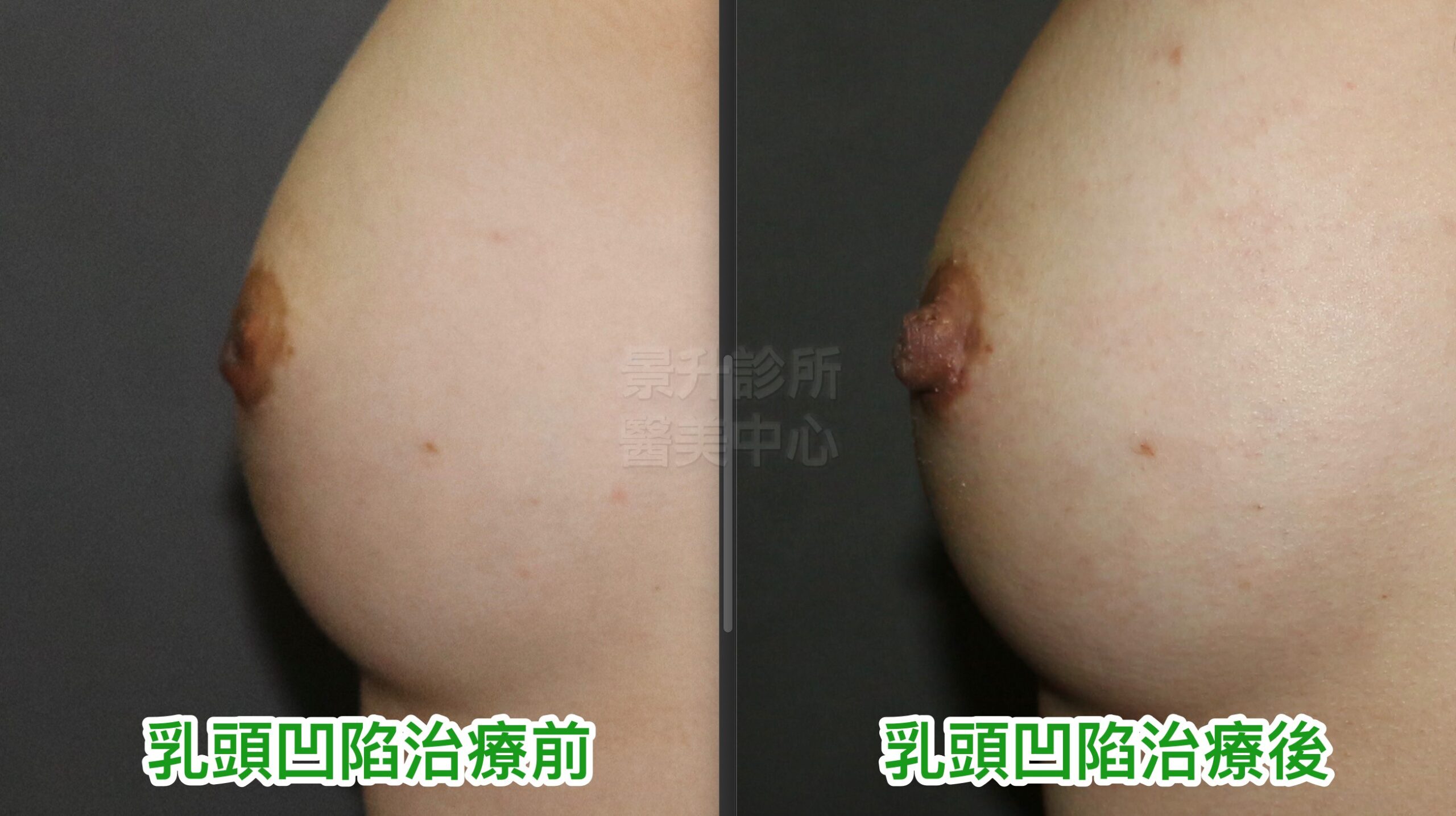 乳頭凹陷治療前後圖3