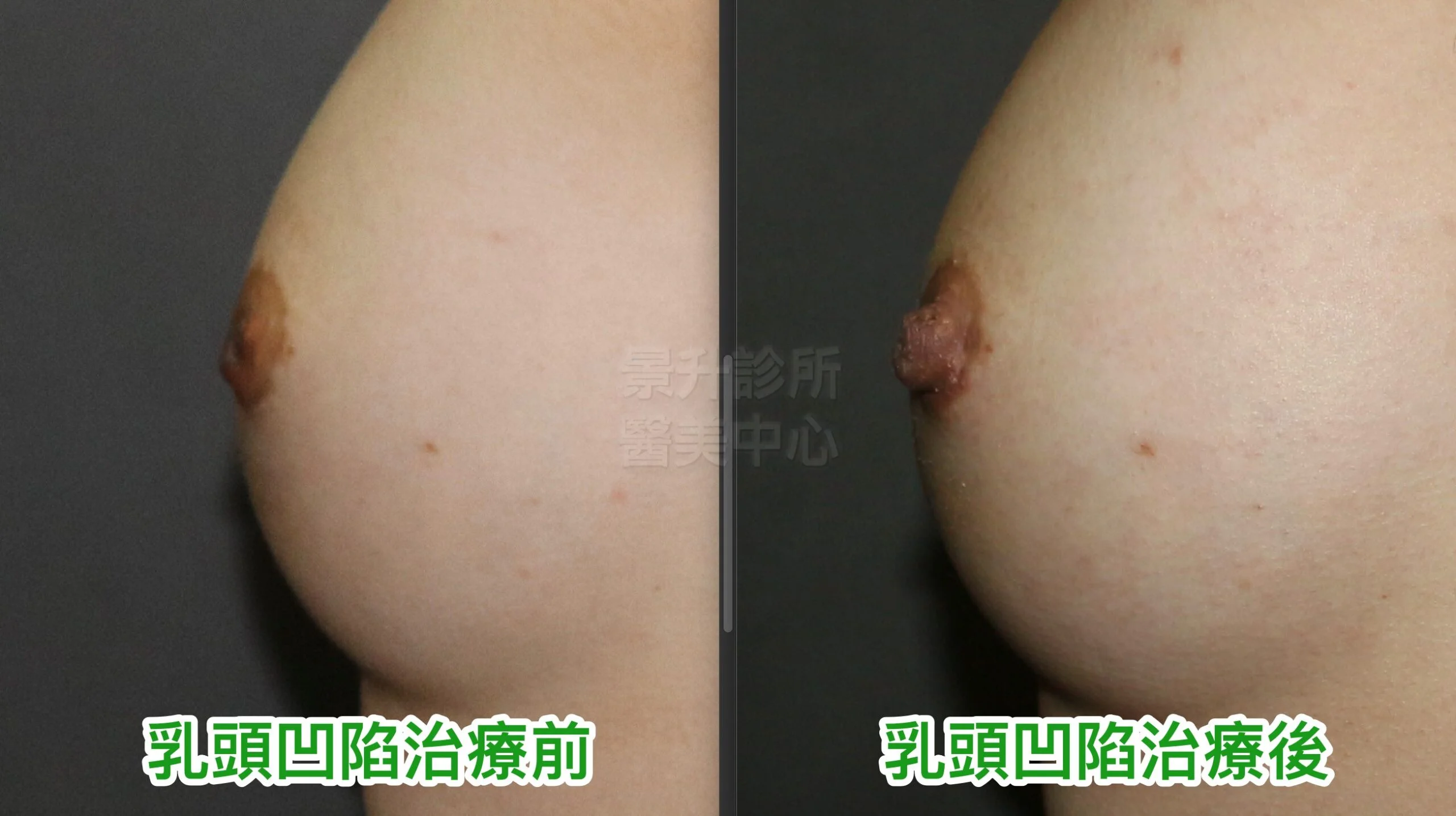 乳頭凹陷治療前後圖3