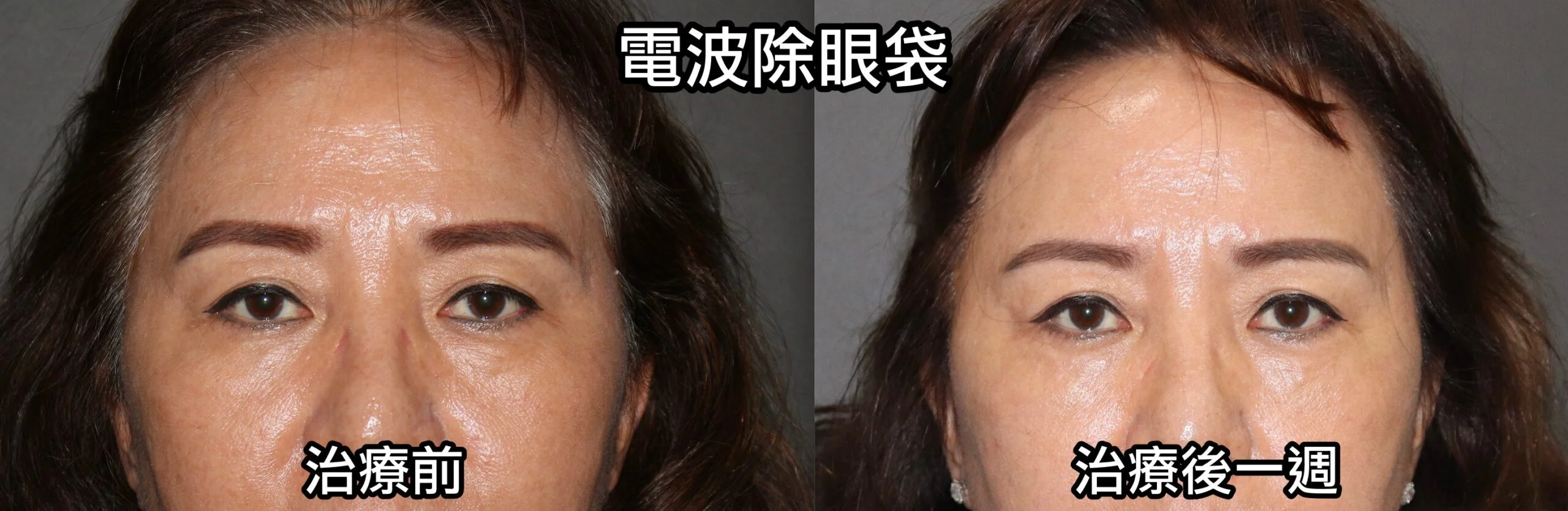 消除眼袋的新方法:電波除眼袋 7 電波除眼袋後7天-1