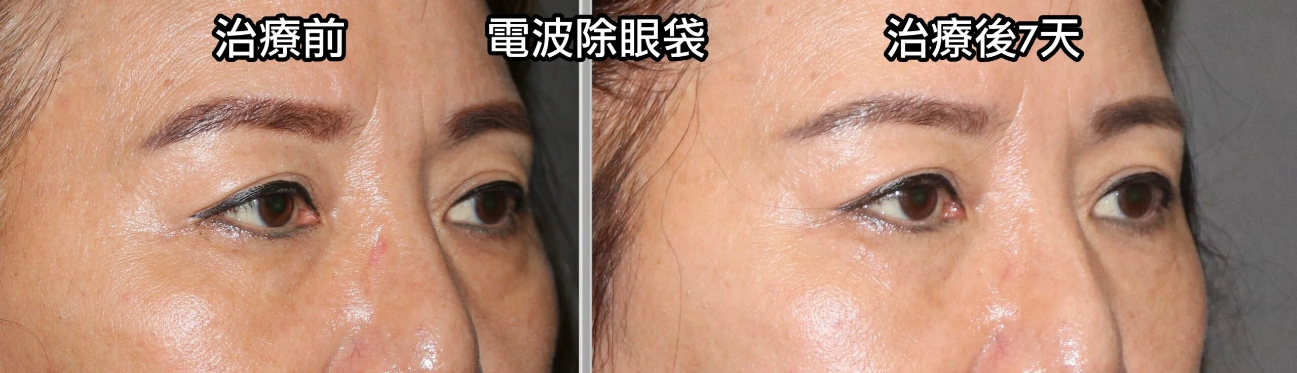 消除眼袋的新方法:電波除眼袋 8 ▲電波除眼袋後7天