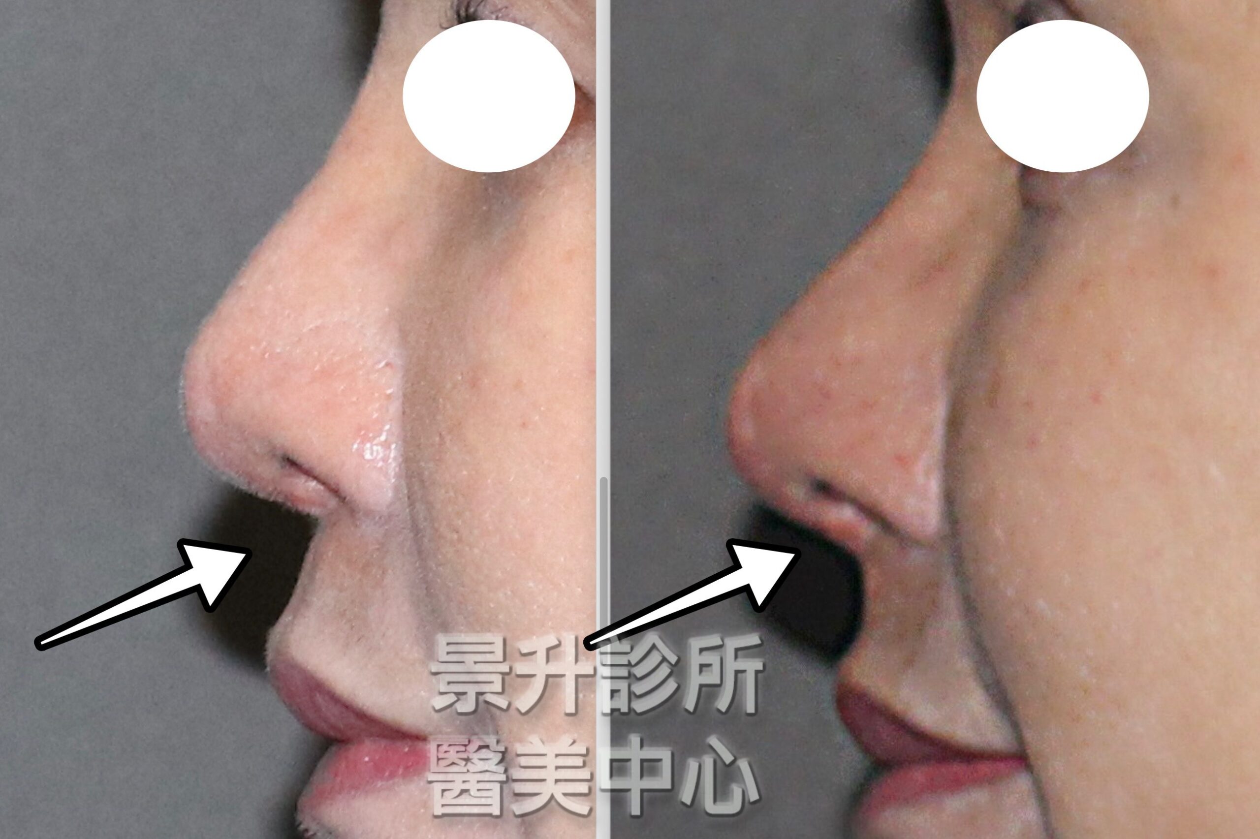玻尿酸隆鼻後，鼻尖更翹更間更挺，鼻中柱和鼻唇角都變漂亮