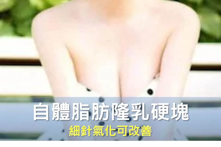 自體脂肪隆乳硬塊不一定要切除，細針氣化〈aeration〉可改善