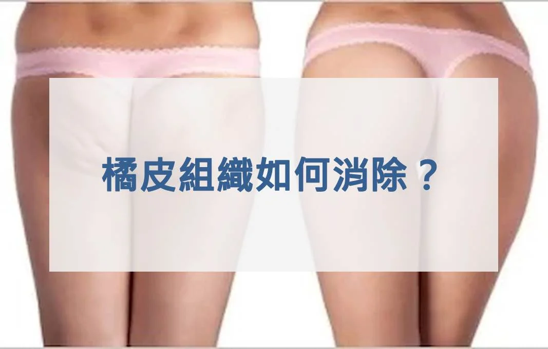 橘皮組織如何消除？