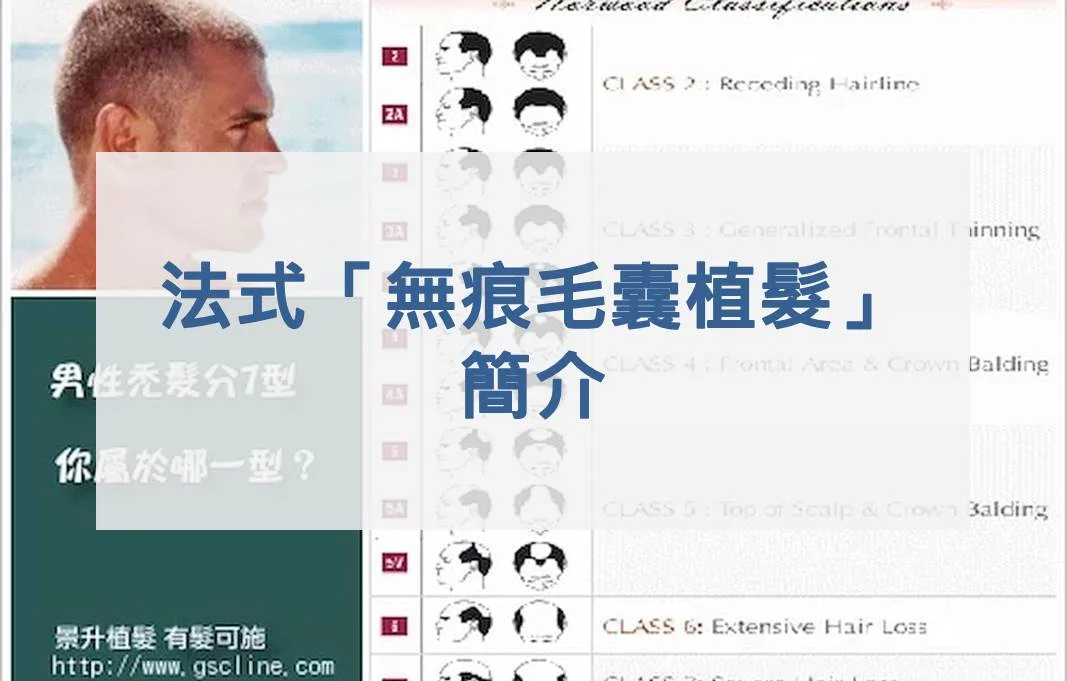 法式「無痕毛囊植髮」簡介
