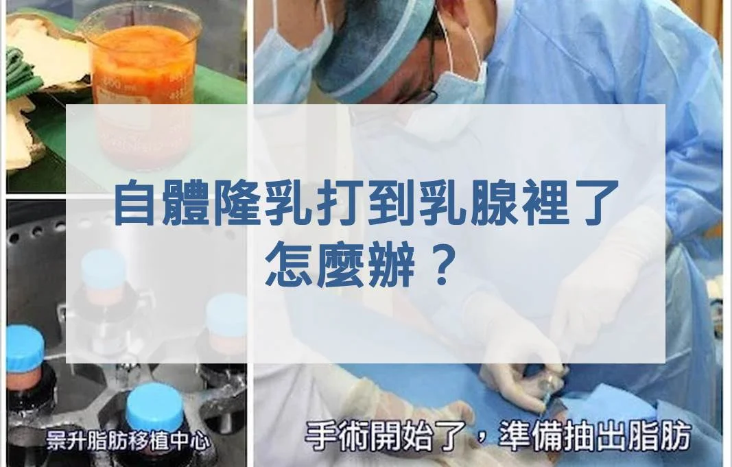 自體脂肪隆乳打到乳腺裡了，怎麼辦？