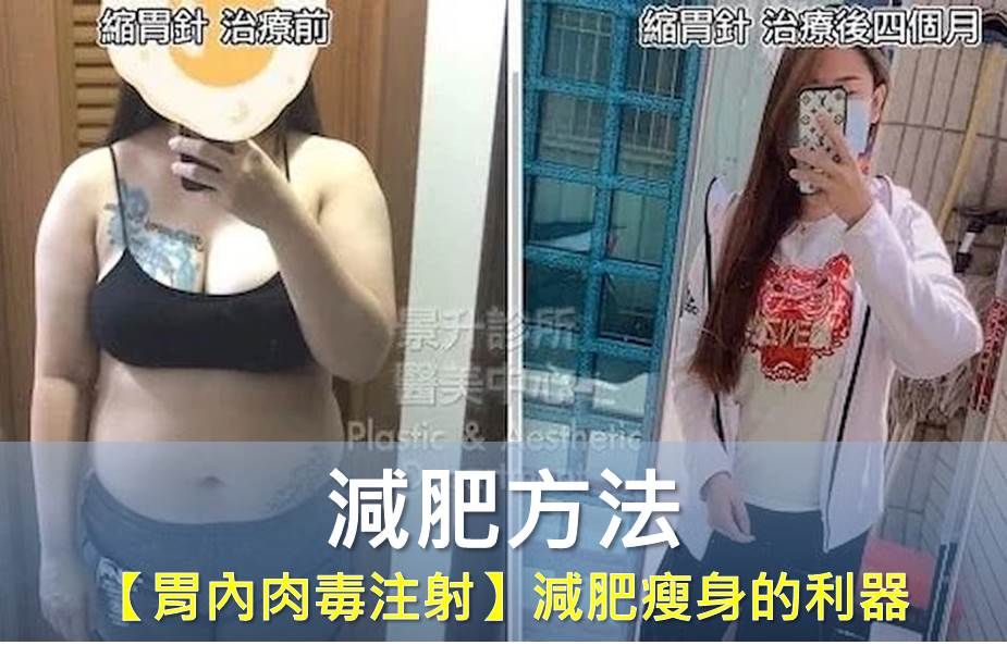 減肥方法 【胃內肉毒注射】減肥瘦身的利器