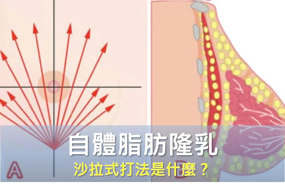 自體脂肪隆乳 沙拉式打法是什麼？