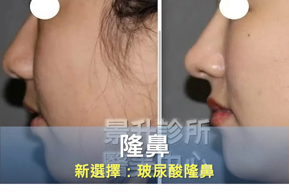 隆鼻的新選擇：玻尿酸隆鼻