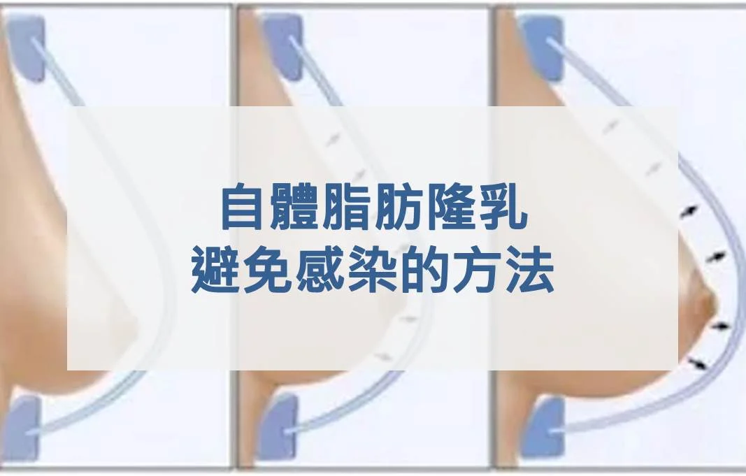 自體脂肪隆乳避免感染的方法