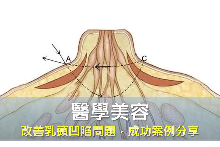 乳頭凹陷造成清潔不易，餵乳困難，男女都有，成功案例分享