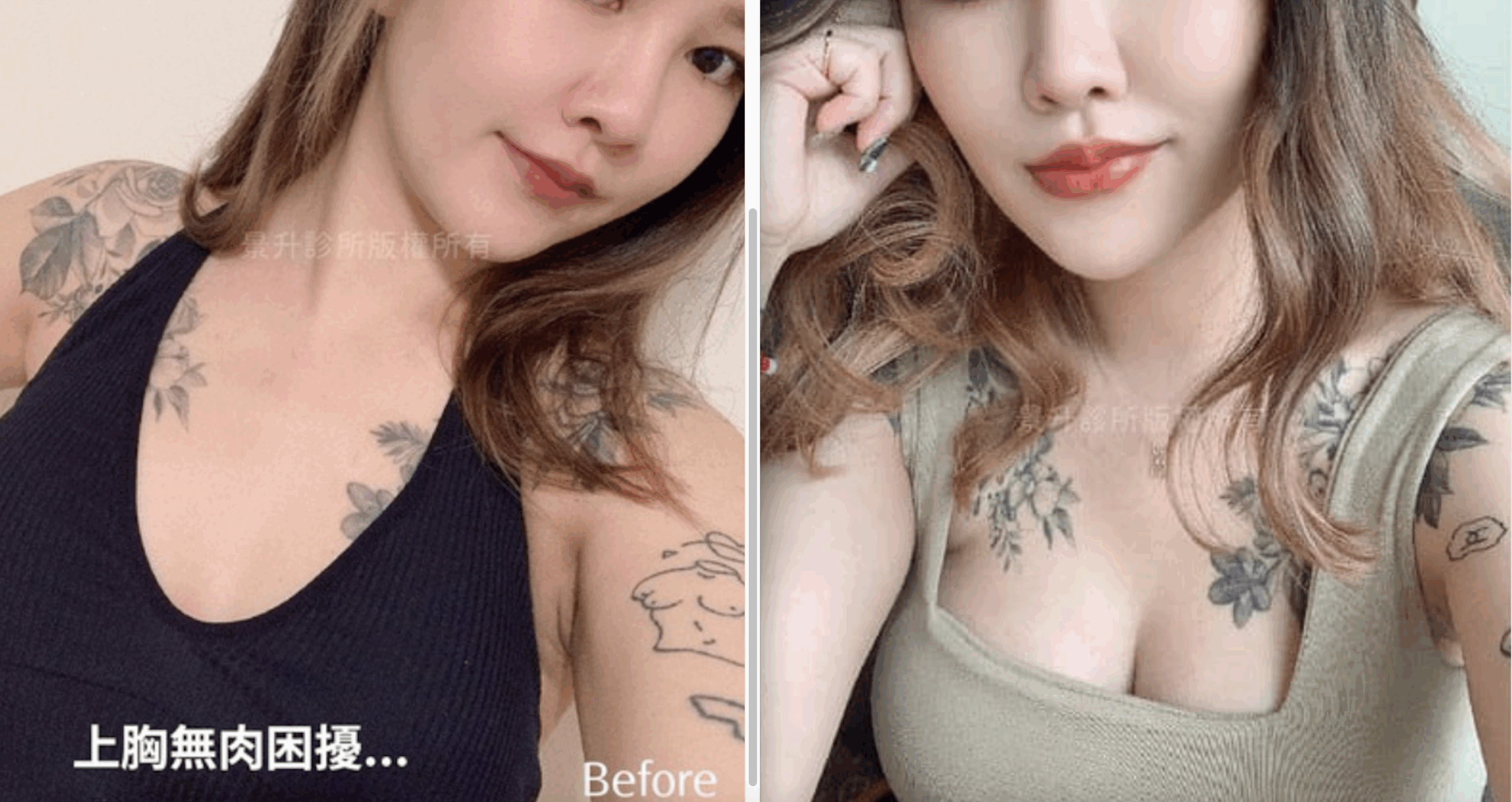 體重過輕也能擁有自然美胸!一篇醫學研究揭露自體脂肪隆乳的適用對象 6 體重過輕也能擁有自然美胸!一篇醫學研究揭露自體脂肪隆乳的適用對象