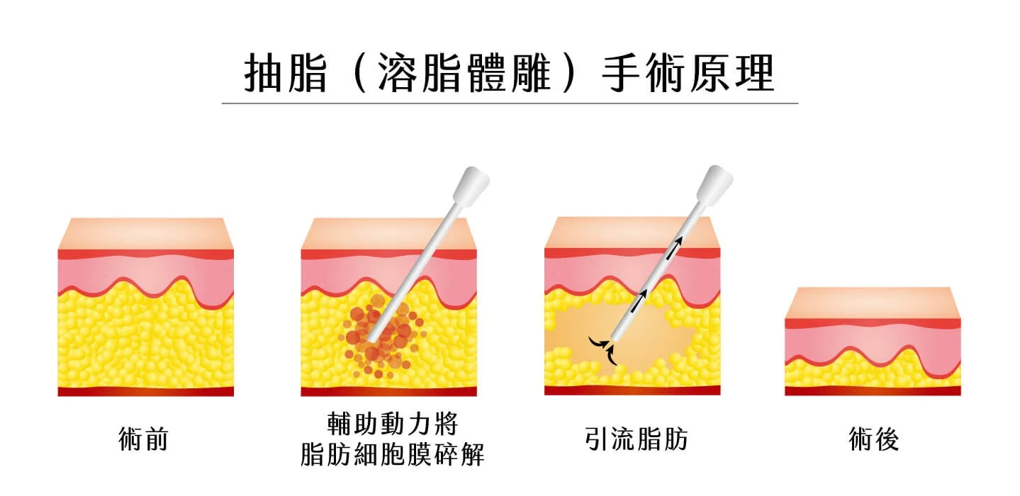脂肪無影踪:6個超音波溶脂的絕佳效果揭密 9 超音波溶脂_超音波溶脂抽脂手術原理_景升診所