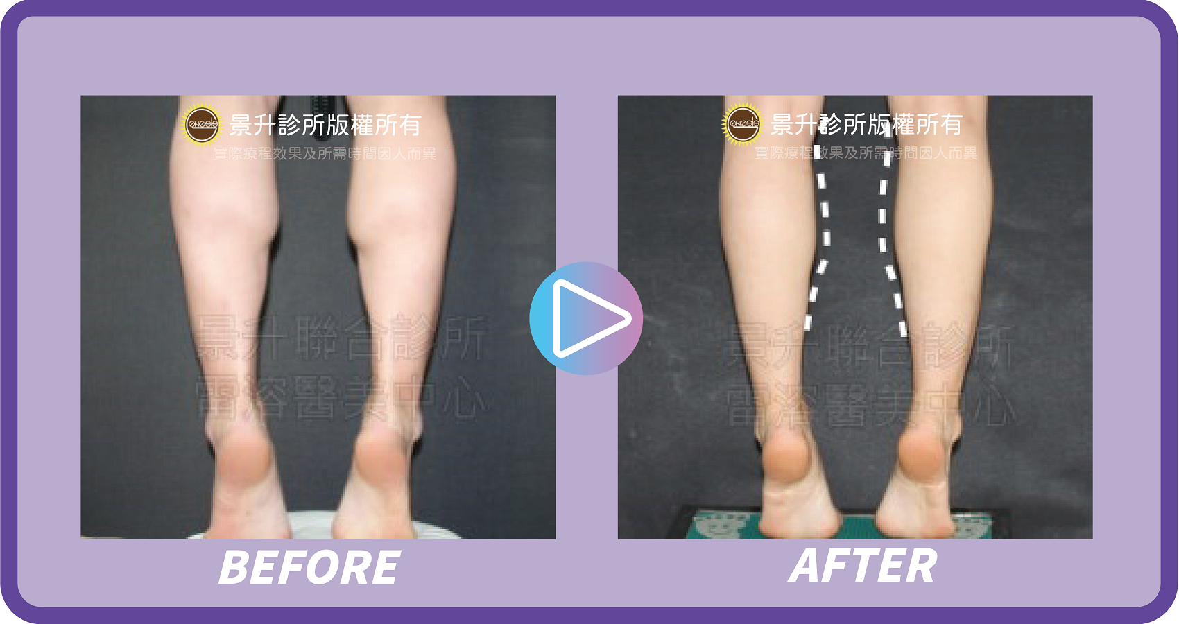 瘦小腿(肌肉型)手術揮別粗壯蘿蔔腿 - 景升診所 景升診所 自體脂肪論文 連續七年刊登國際期刊 瘦小腿(肌肉型)手術揮別粗壯蘿蔔腿 案例1 11