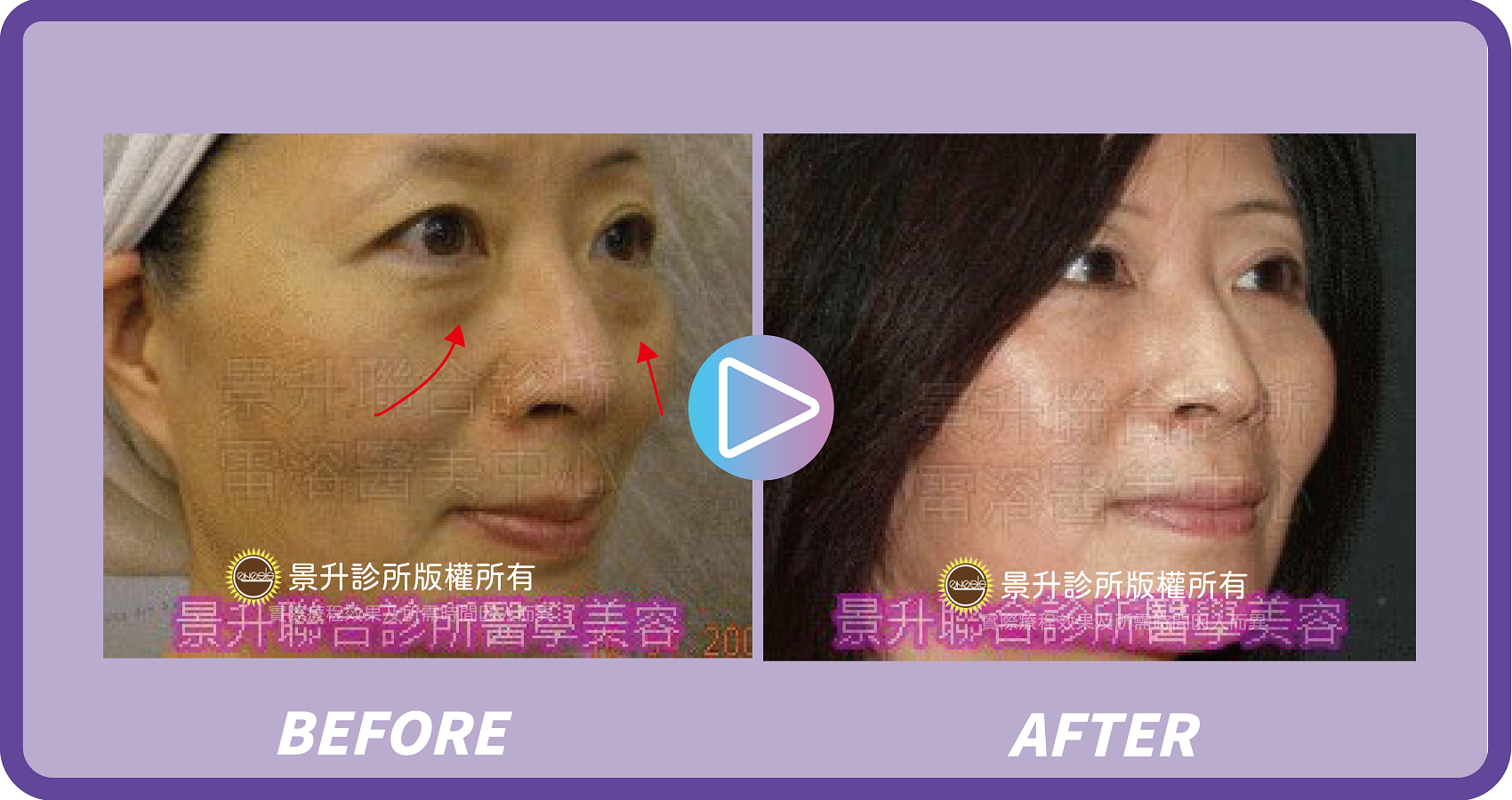 肉毒桿菌瘦小臉除皺 視覺逆齡小秘密 - 景升診所 景升診所 自體脂肪論文 連續七年刊登國際期刊 肉毒桿菌瘦小臉除皺 視覺逆齡小秘密 案例1 12