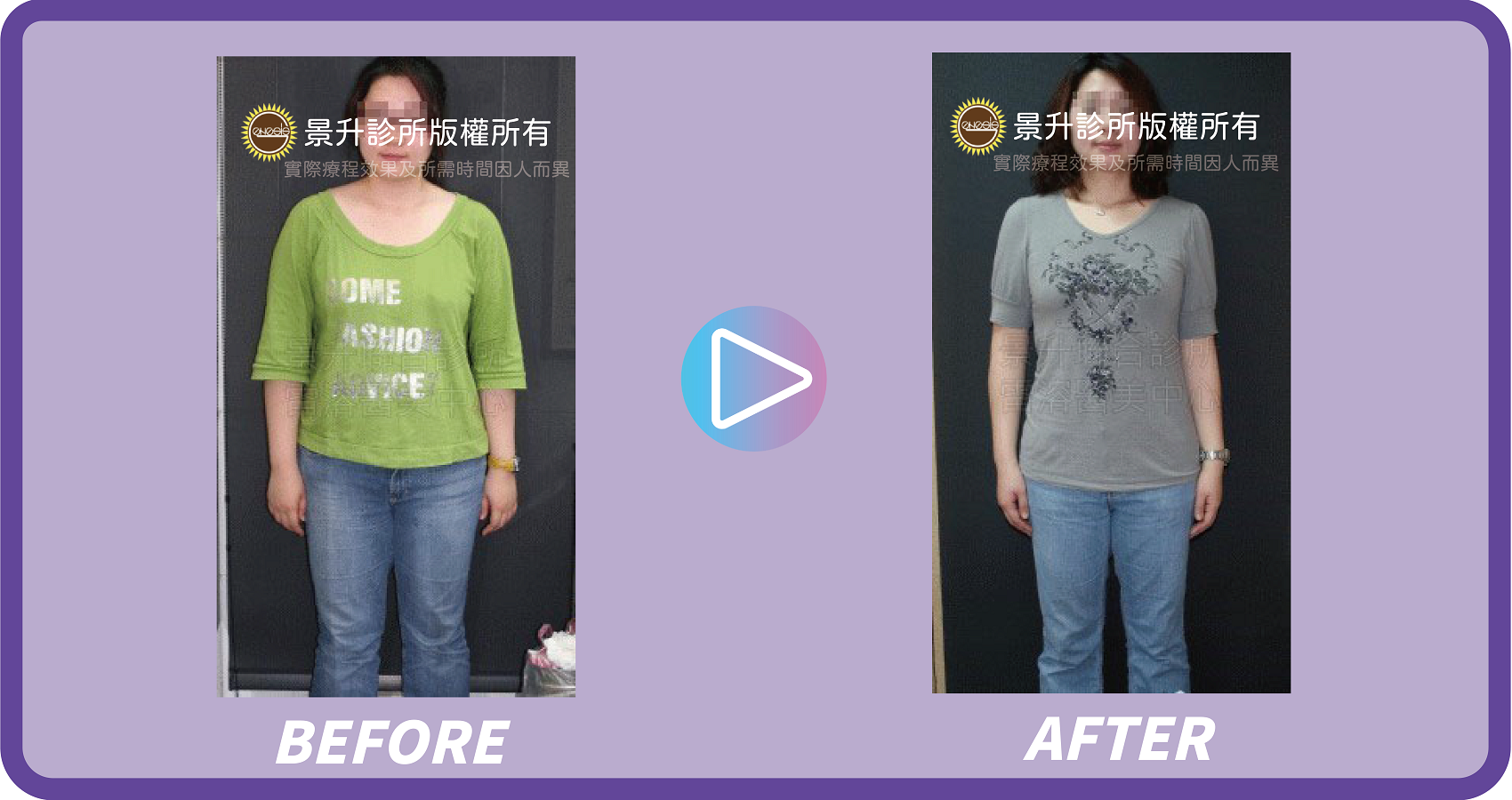 肥胖症治療 量身規劃減重計畫 - 景升診所 景升診所 自體脂肪論文 連續七年刊登國際期刊 肥胖症治療 量身規劃減重計畫 案例1 13