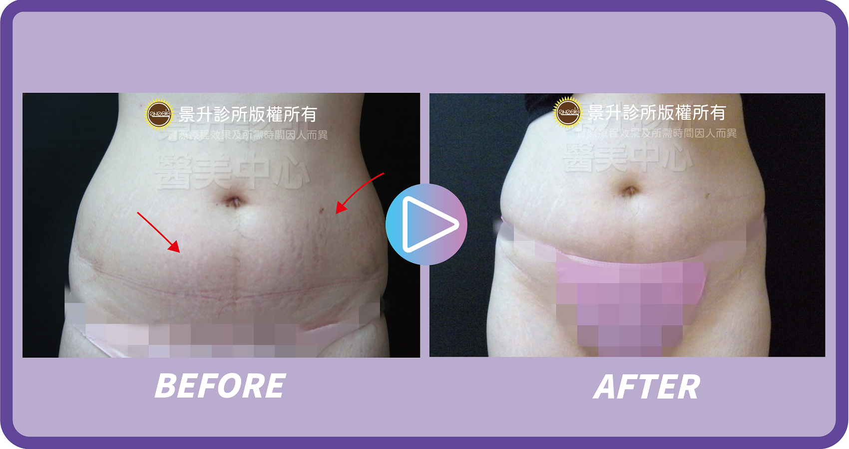 醫美淡化妊娠紋 恢復肚皮光滑緊實 - 景升診所 景升診所 自體脂肪論文 連續七年刊登國際期刊 醫美淡化妊娠紋 恢復肚皮光滑緊實 案例1 15