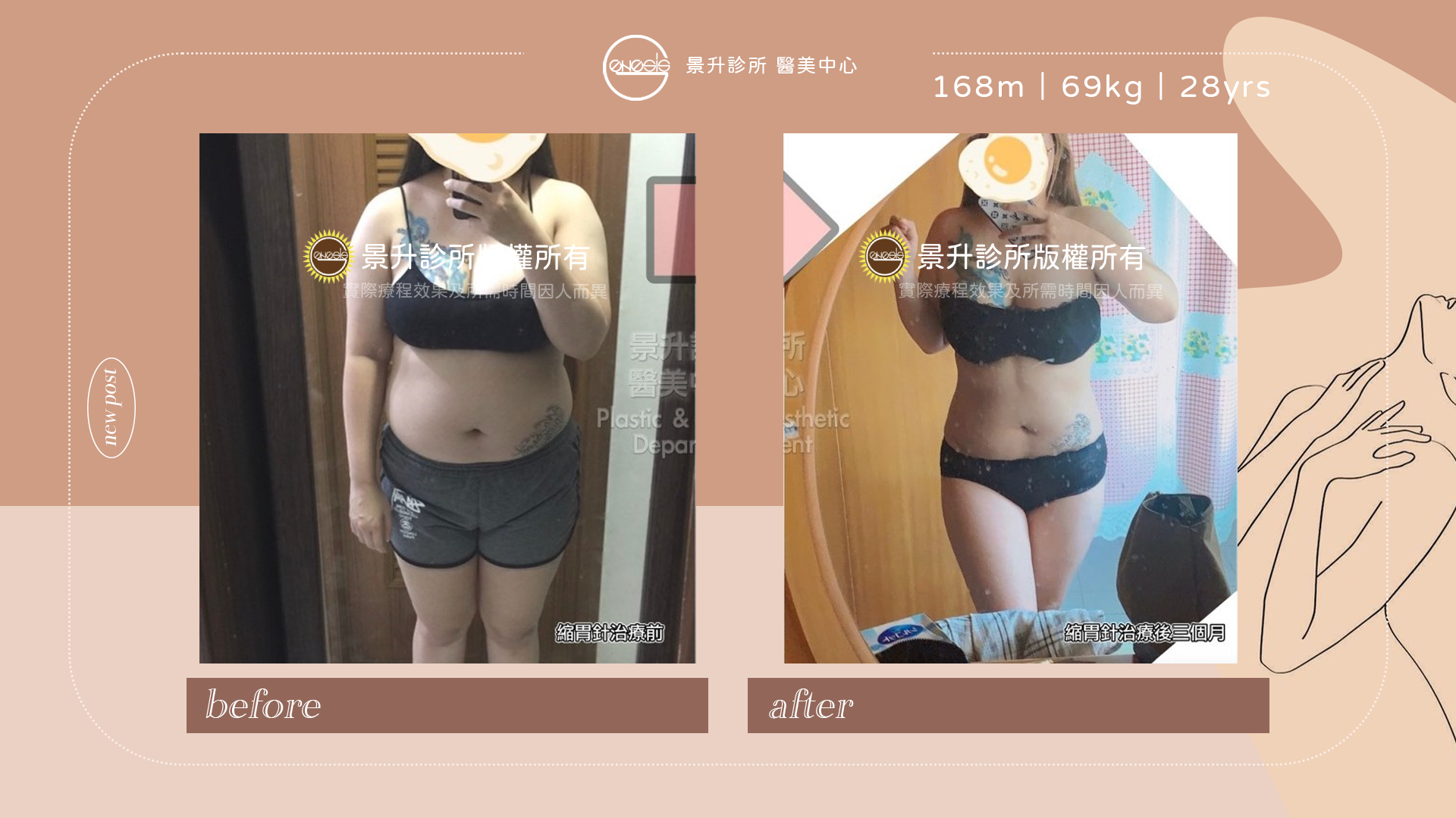 縮胃針(胃內肉毒桿菌注射)抑制食慾 - 景升診所 縮胃針胃內肉毒輔助減肥歷程,實際效果與所需時間因人而異