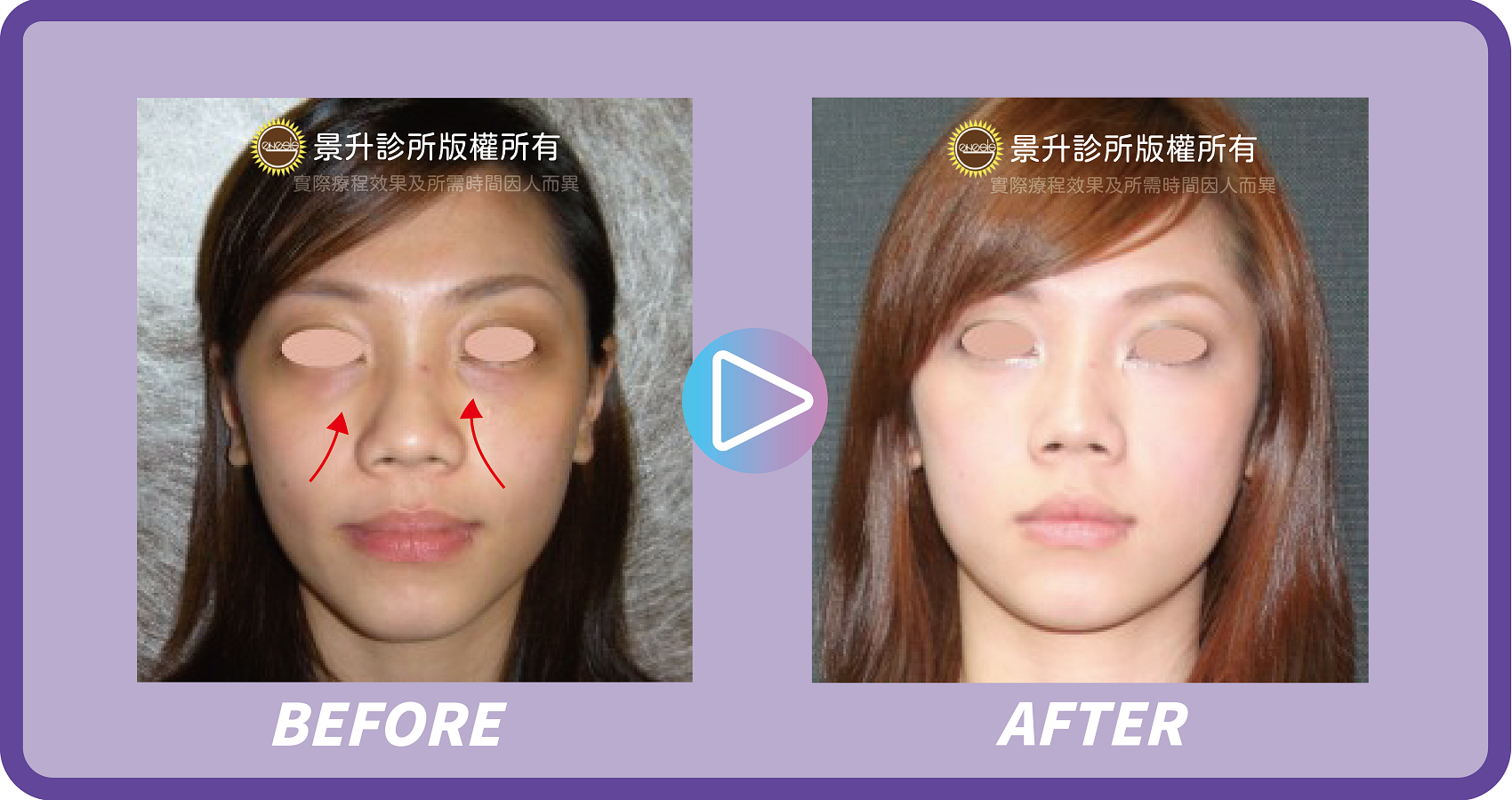 玻尿酸填補 微調五官立體重拾年輕 - 景升診所 景升診所 自體脂肪論文 連續七年刊登國際期刊 玻尿酸填補 微調五官立體重拾年輕 案例1 8