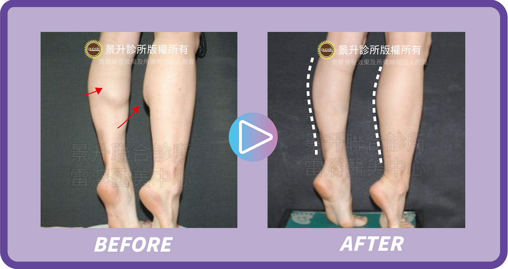 瘦小腿(肌肉型)手術揮別粗壯蘿蔔腿 - 景升診所 景升診所 自體脂肪論文 連續七年刊登國際期刊 瘦小腿(肌肉型)手術揮別粗壯蘿蔔腿 案例2 11