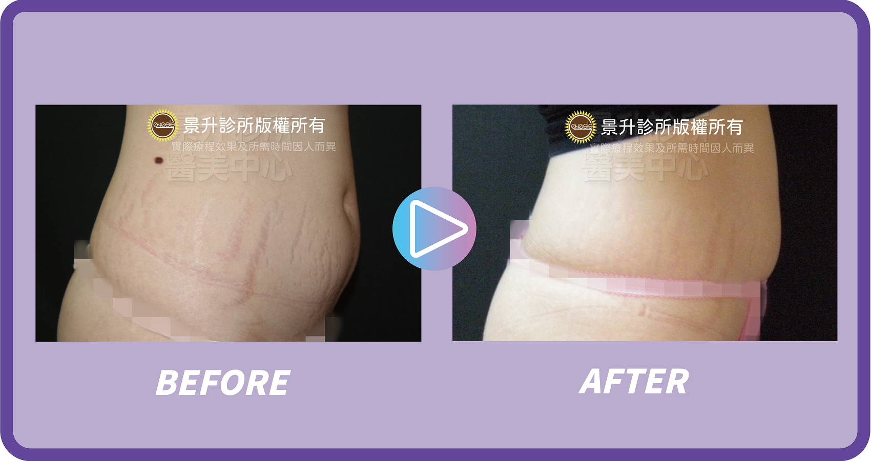 醫美淡化妊娠紋 恢復肚皮光滑緊實 - 景升診所 景升診所 自體脂肪論文 連續七年刊登國際期刊 醫美淡化妊娠紋 恢復肚皮光滑緊實 案例2 15