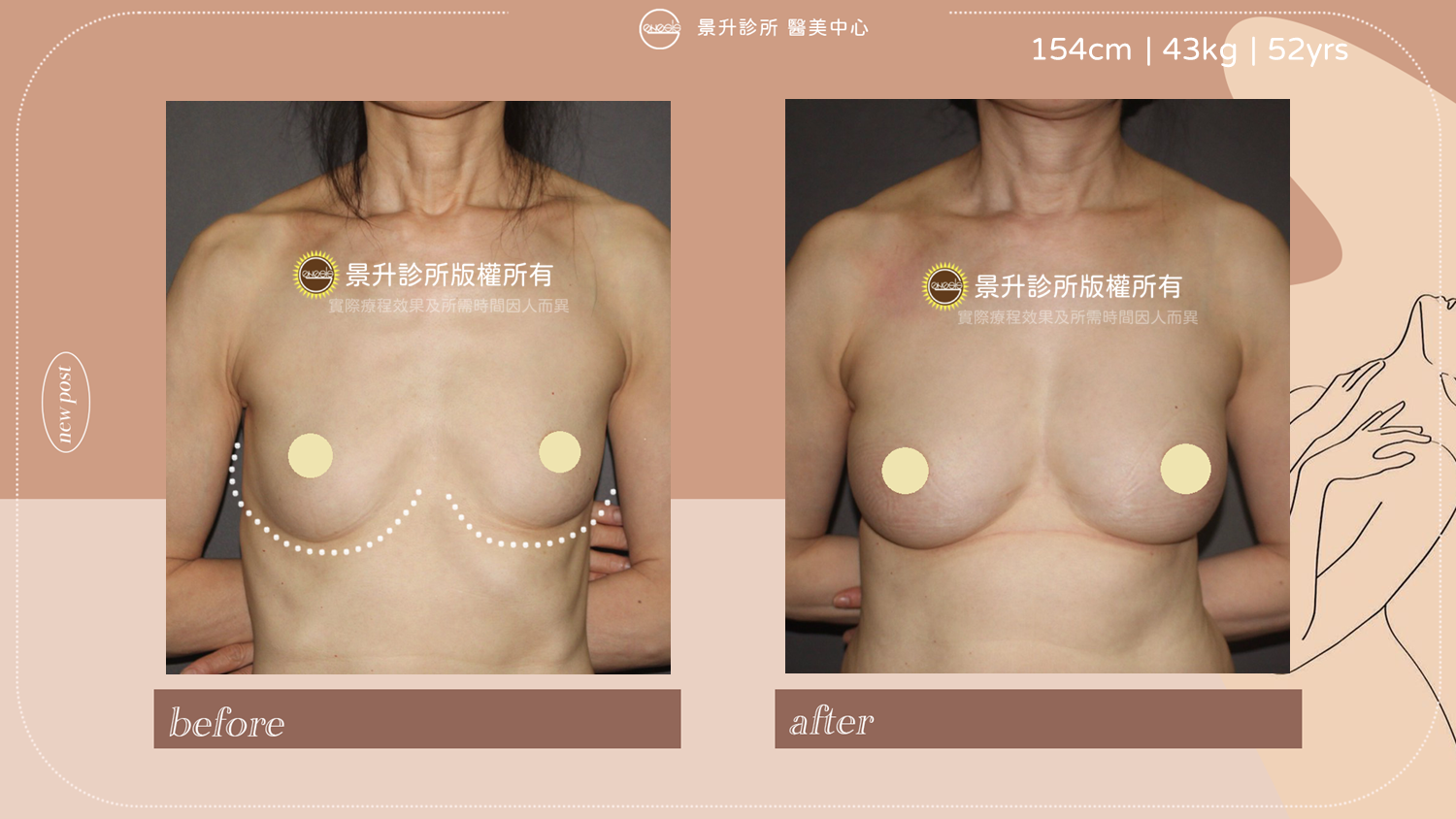 自體脂肪隆乳豐胸手術改善胸部產後萎縮的問題