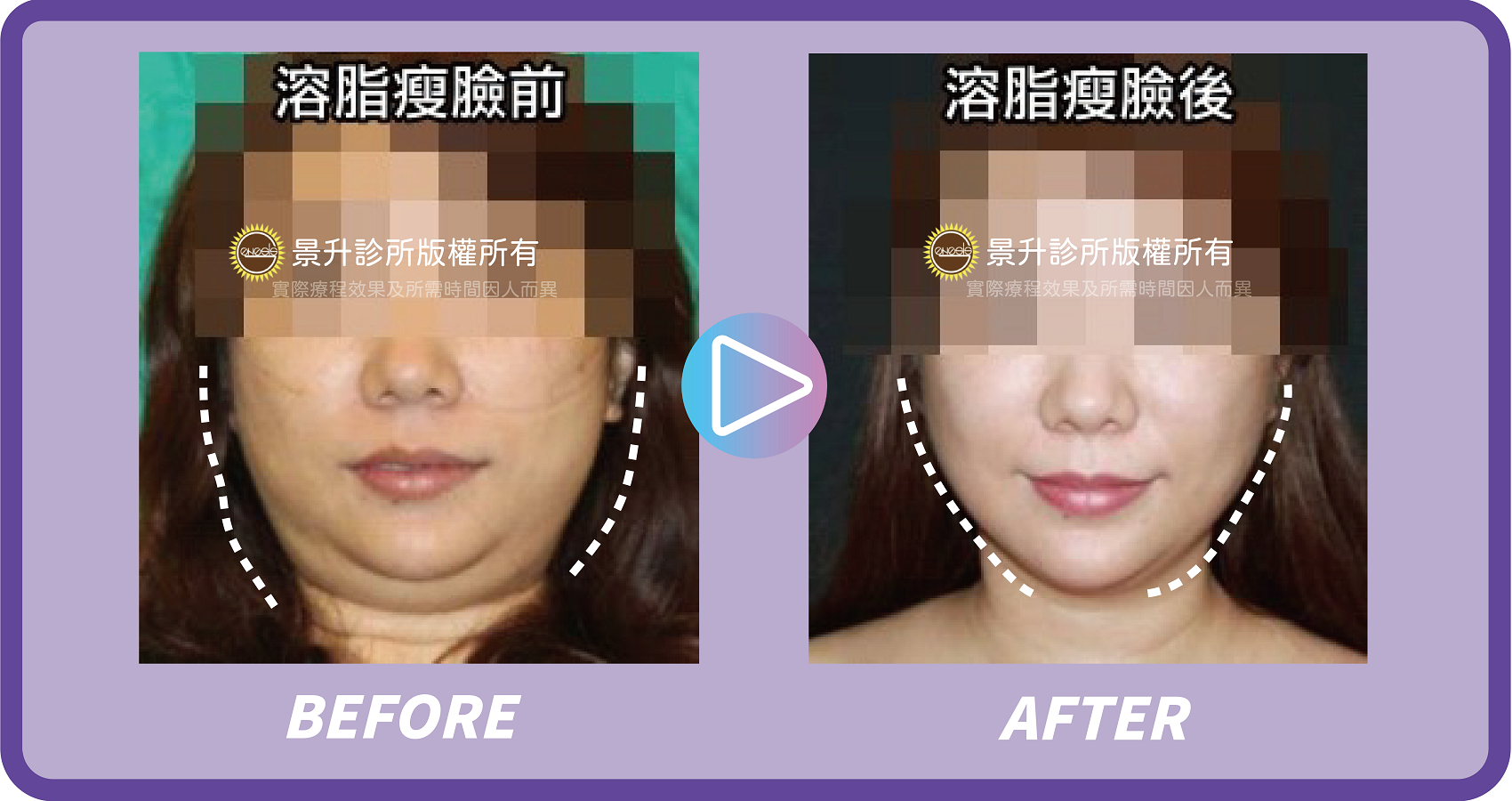 抽脂瘦臉手術 打造精緻瓜子臉 - 景升診所 景升診所 自體脂肪論文 連續七年刊登國際期刊 抽脂瘦臉手術 打造精緻瓜子臉 案例2 21
