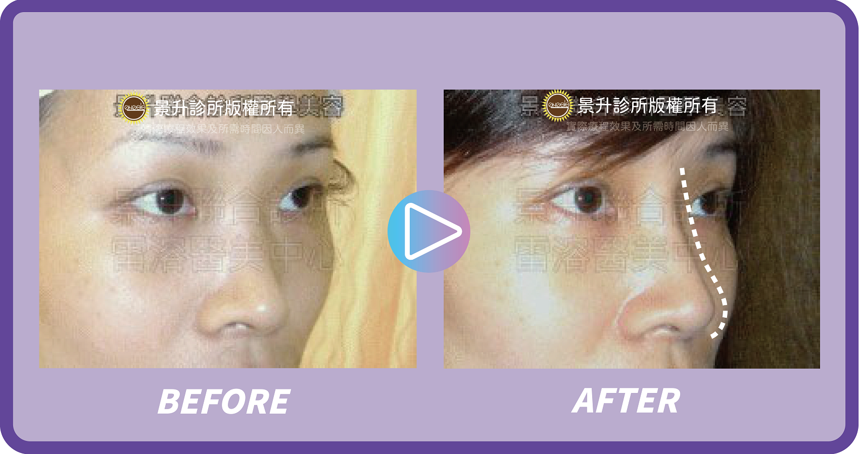 玻尿酸填補 微調五官立體重拾年輕 - 景升診所 景升診所 自體脂肪論文 連續七年刊登國際期刊 玻尿酸填補 微調五官立體重拾年輕 案例2 8