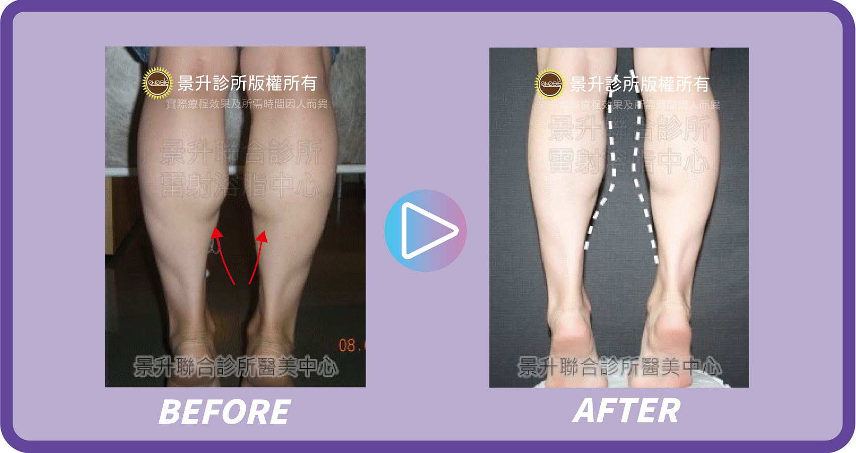 瘦小腿(肌肉型)手術揮別粗壯蘿蔔腿 - 景升診所 景升診所 自體脂肪論文 連續七年刊登國際期刊 瘦小腿(肌肉型)手術揮別粗壯蘿蔔腿 案例3 10