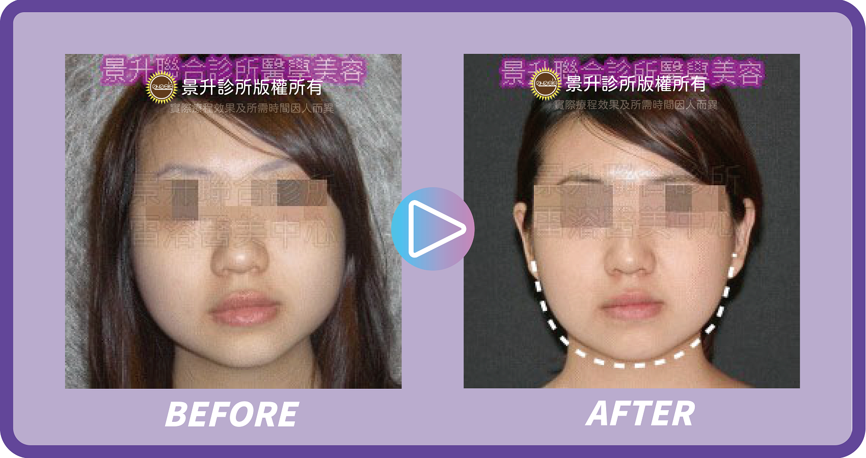 肉毒桿菌瘦小臉除皺 視覺逆齡小秘密 - 景升診所 景升診所 自體脂肪論文 連續七年刊登國際期刊 肉毒桿菌瘦小臉除皺 視覺逆齡小秘密 案例3 11