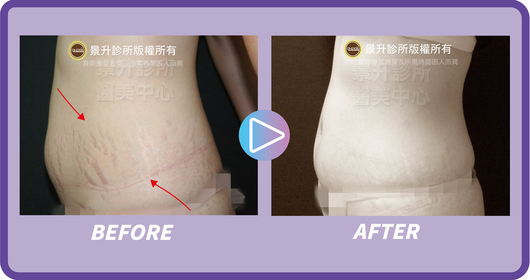 醫美淡化妊娠紋 恢復肚皮光滑緊實 - 景升診所 景升診所 自體脂肪論文 連續七年刊登國際期刊 醫美淡化妊娠紋 恢復肚皮光滑緊實 案例3 13