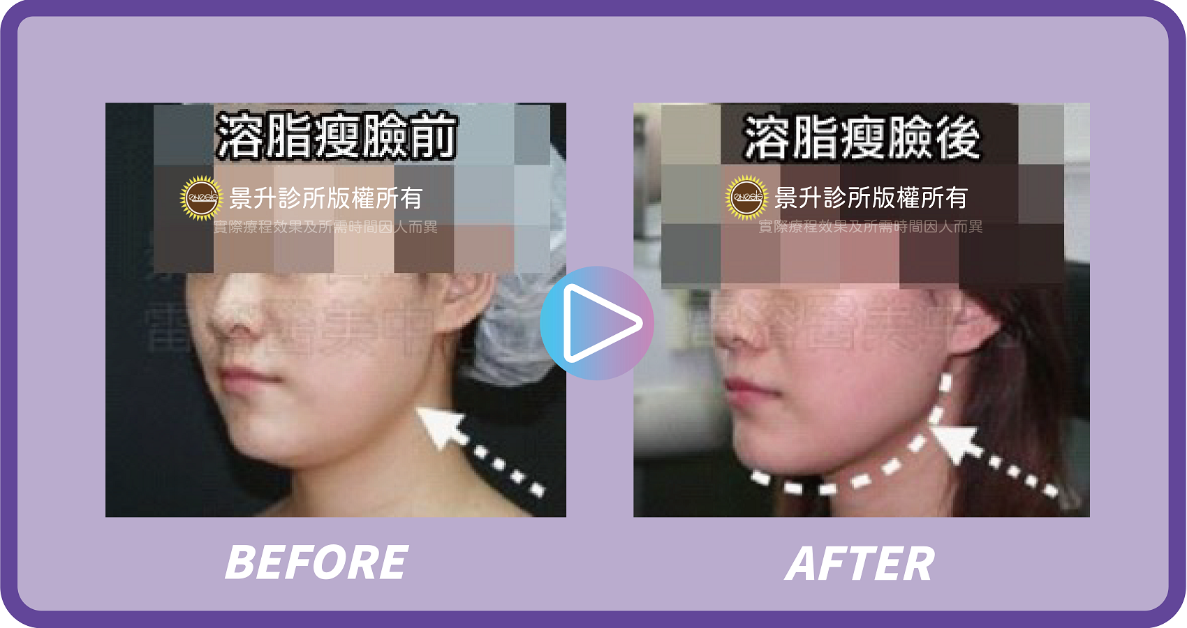 抽脂瘦臉手術 打造精緻瓜子臉 - 景升診所 景升診所 自體脂肪論文 連續七年刊登國際期刊 抽脂瘦臉手術 打造精緻瓜子臉 案例3 19