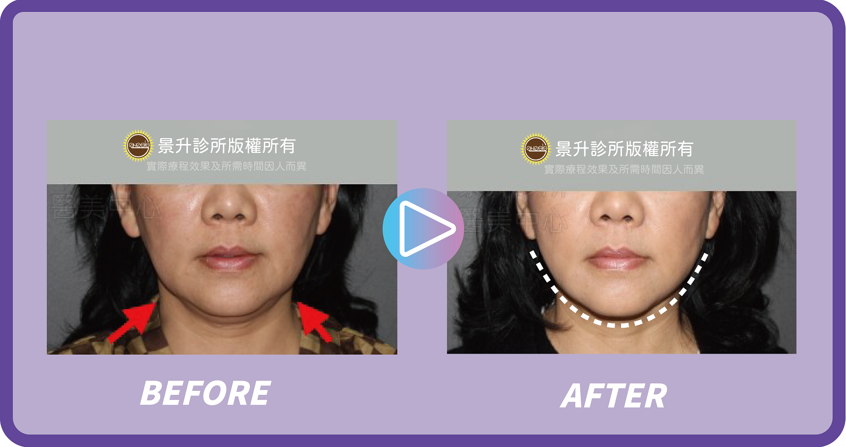 埋線拉提緊實肌膚 微創不須漫長恢復期 - 景升診所 景升診所 自體脂肪論文 連續七年刊登國際期刊 埋線拉提緊實肌膚 微創不須漫長恢復期 案例3 7