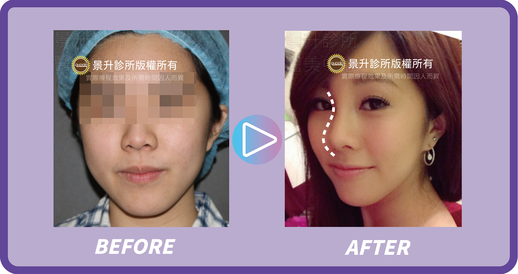 玻尿酸填補 微調五官立體重拾年輕 - 景升診所 景升診所 自體脂肪論文 連續七年刊登國際期刊 玻尿酸填補 微調五官立體重拾年輕 案例3 8