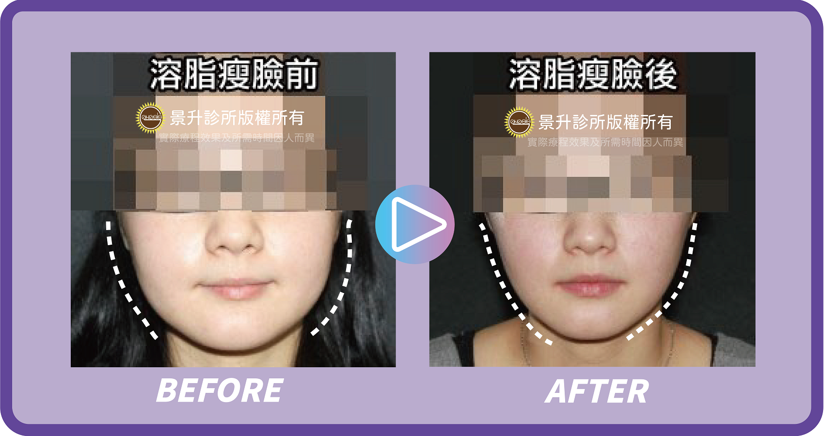 抽脂瘦臉手術 打造精緻瓜子臉 - 景升診所 景升診所 自體脂肪論文 連續七年刊登國際期刊 抽脂瘦臉手術 打造精緻瓜子臉 案例4 12