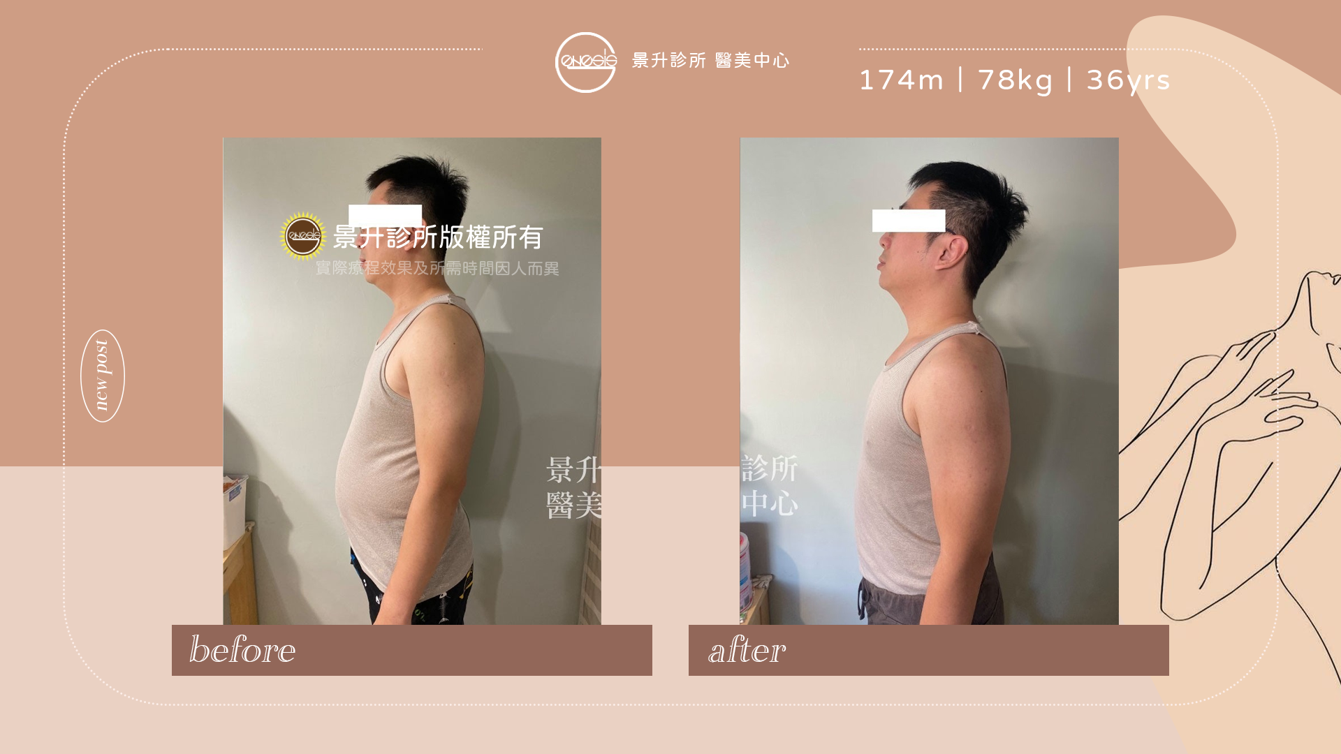 縮胃針(胃內肉毒桿菌注射)抑制食慾 - 景升診所 胃內肉毒素注射(俗稱縮胃針)幫助減肥 順利瘦下惱人啤酒肚