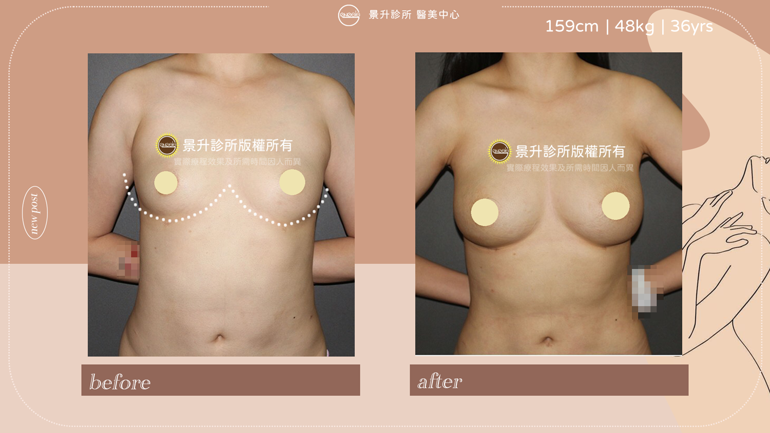 自體脂肪隆乳豐胸手術順帶雕塑體態的附加效果