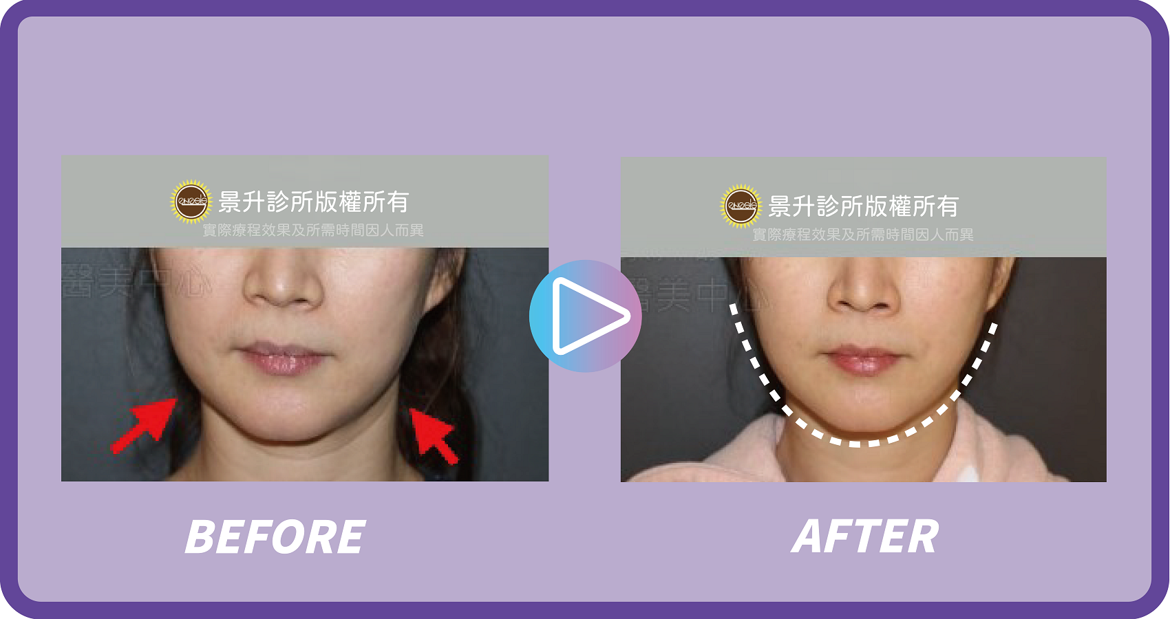 埋線拉提緊實肌膚 微創不須漫長恢復期 - 景升診所 景升診所 自體脂肪論文 連續七年刊登國際期刊 埋線拉提緊實肌膚 微創不須漫長恢復期 案例4 4