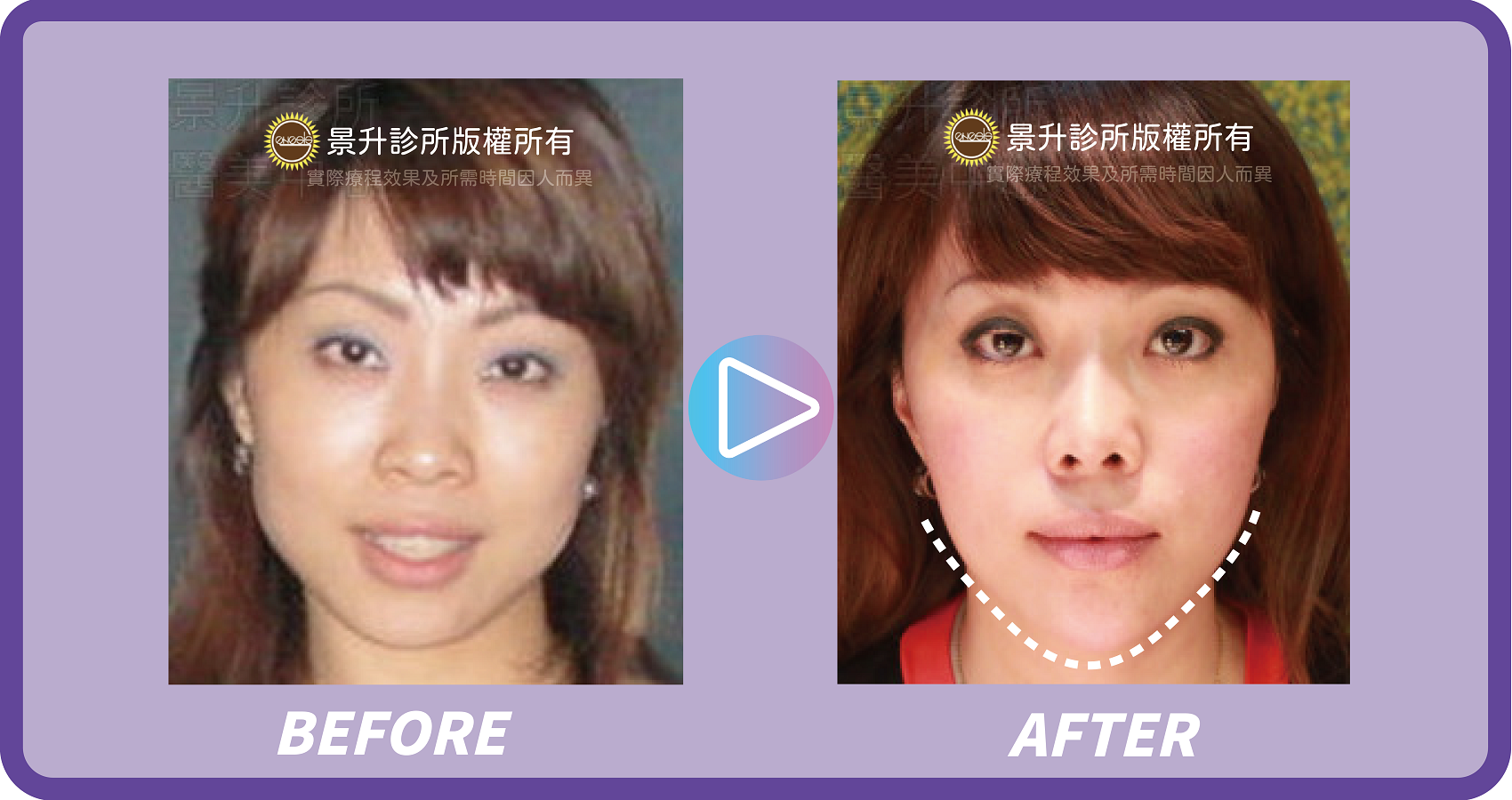 玻尿酸填補 微調五官立體重拾年輕 - 景升診所 景升診所 自體脂肪論文 連續七年刊登國際期刊 玻尿酸填補 微調五官立體重拾年輕 案例4 5