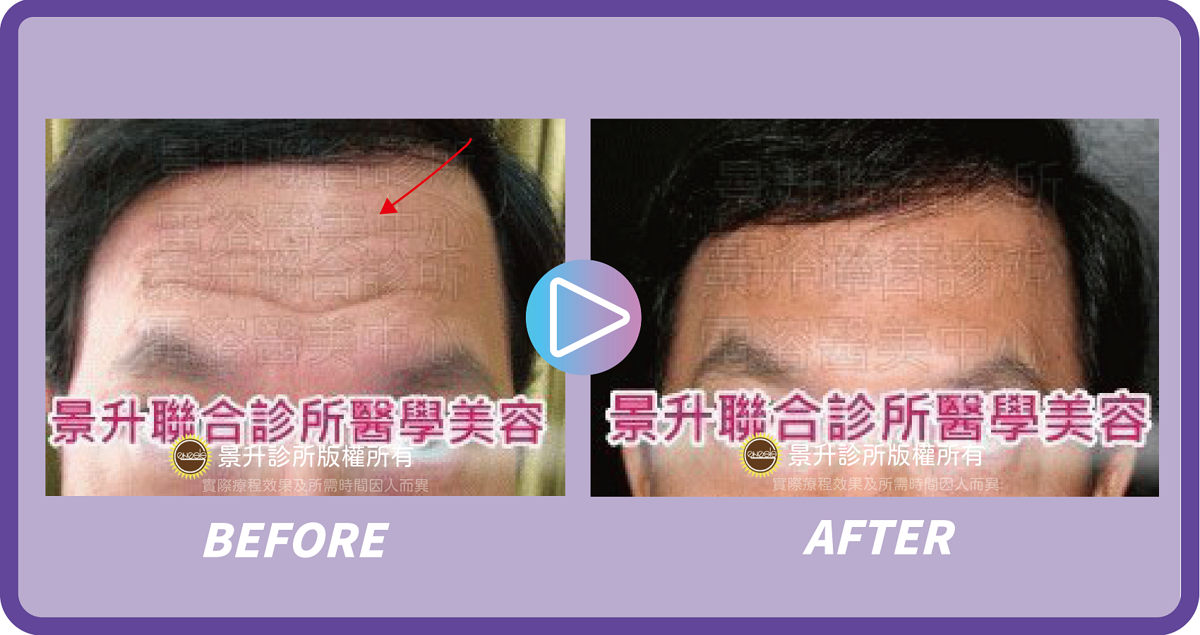 肉毒桿菌瘦小臉除皺 視覺逆齡小秘密 - 景升診所 景升診所 自體脂肪論文 連續七年刊登國際期刊 肉毒桿菌瘦小臉除皺 視覺逆齡小秘密 案例4 6