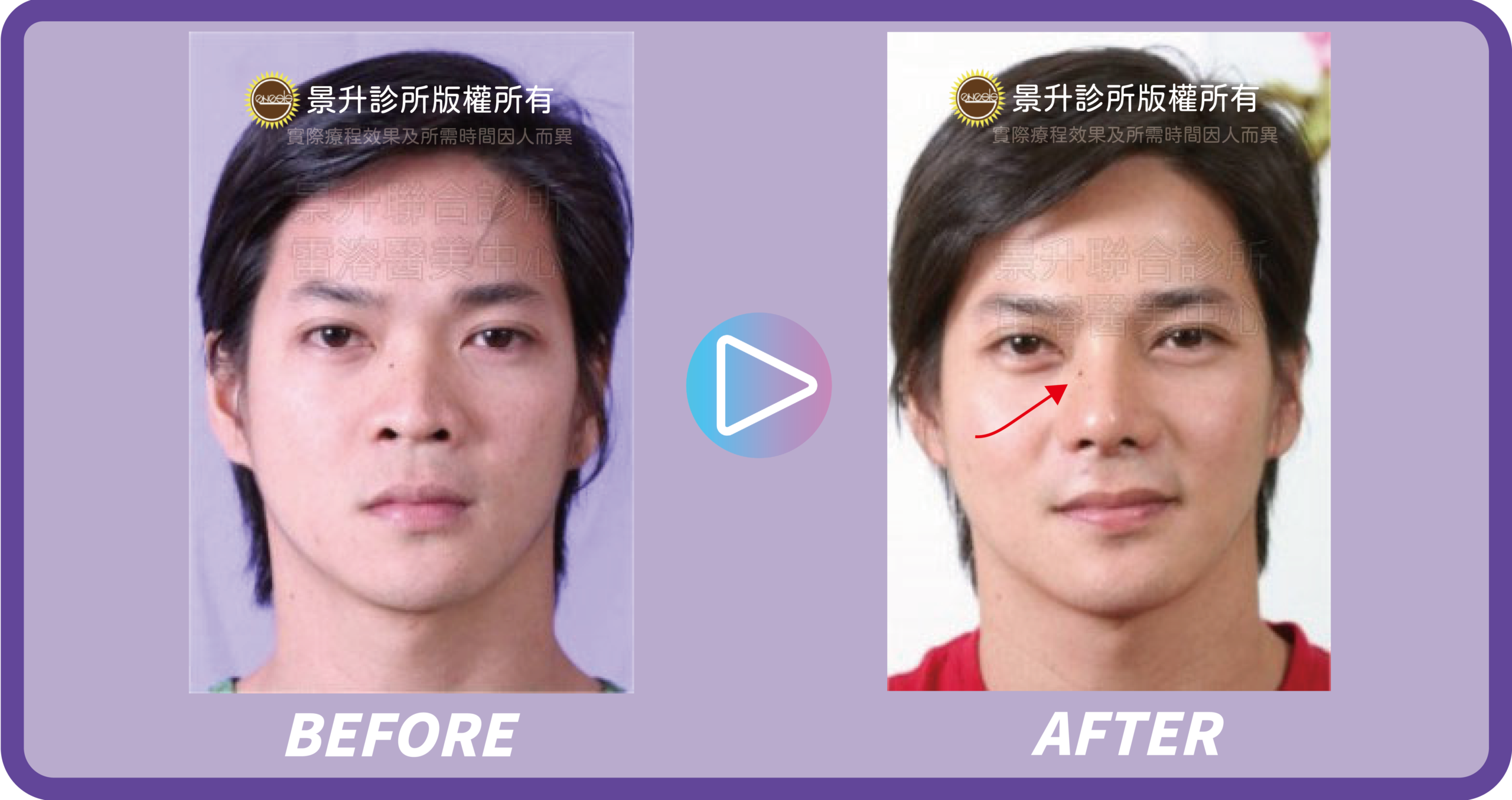 隆鼻手術雕刻挺翹美鼻 五官立體再升級 - 景升診所 景升診所 自體脂肪論文 連續七年刊登國際期刊 隆鼻手術雕刻挺翹美鼻 五官立體再升級 案例4 9