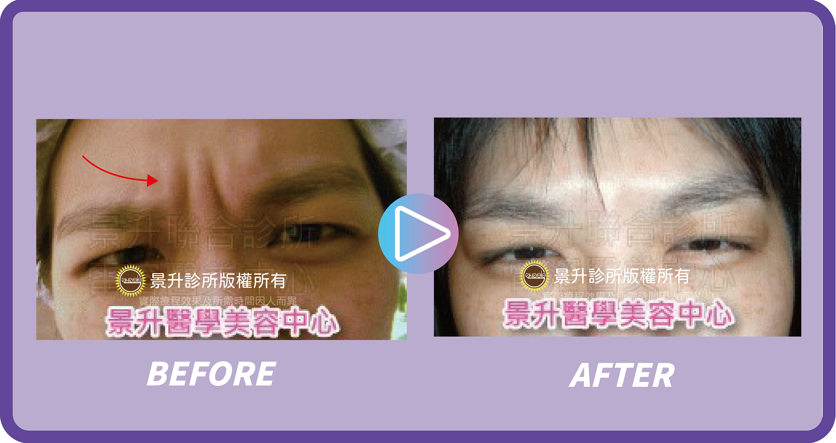 肉毒桿菌瘦小臉除皺 視覺逆齡小秘密 - 景升診所 景升診所 自體脂肪論文 連續七年刊登國際期刊 肉毒桿菌瘦小臉除皺 視覺逆齡小秘密 案例5 1