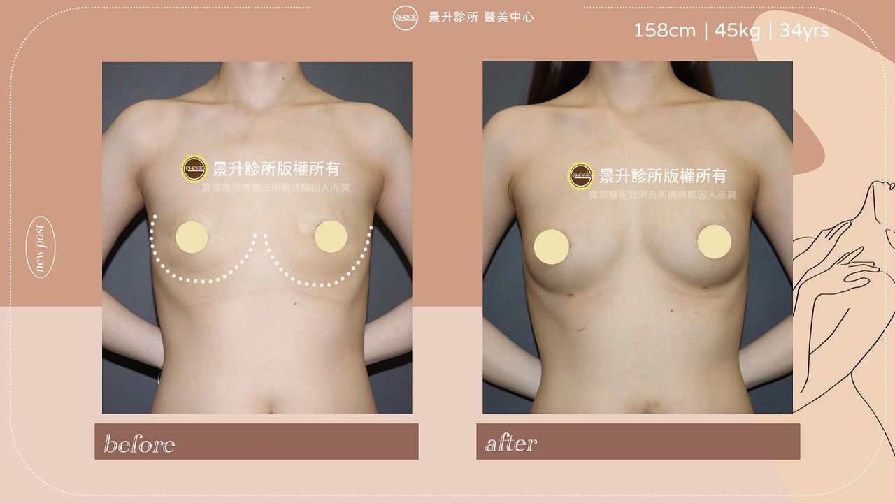 ▲自體脂肪隆乳創造柔軟自然胸型