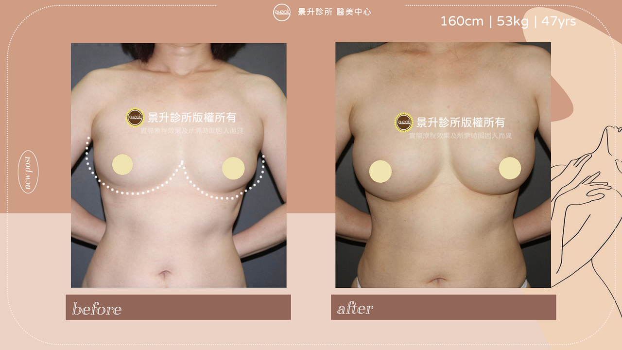 ▲自體脂肪隆乳創造渾圓飽滿胸型