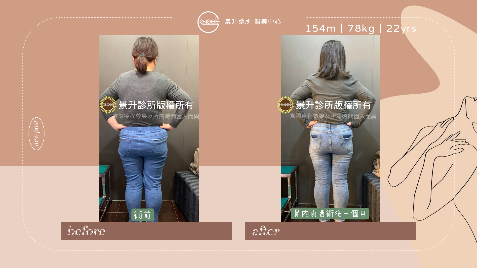 縮胃針(胃內肉毒桿菌注射)抑制食慾 - 景升診所 縮胃針胃內肉毒讓減肥過程飲食控制更順利