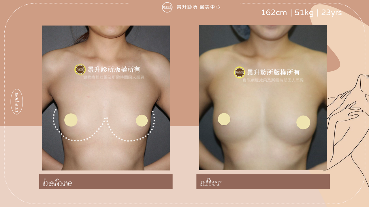 ▲自體脂肪隆乳後胸型呈自然集中垂墜感