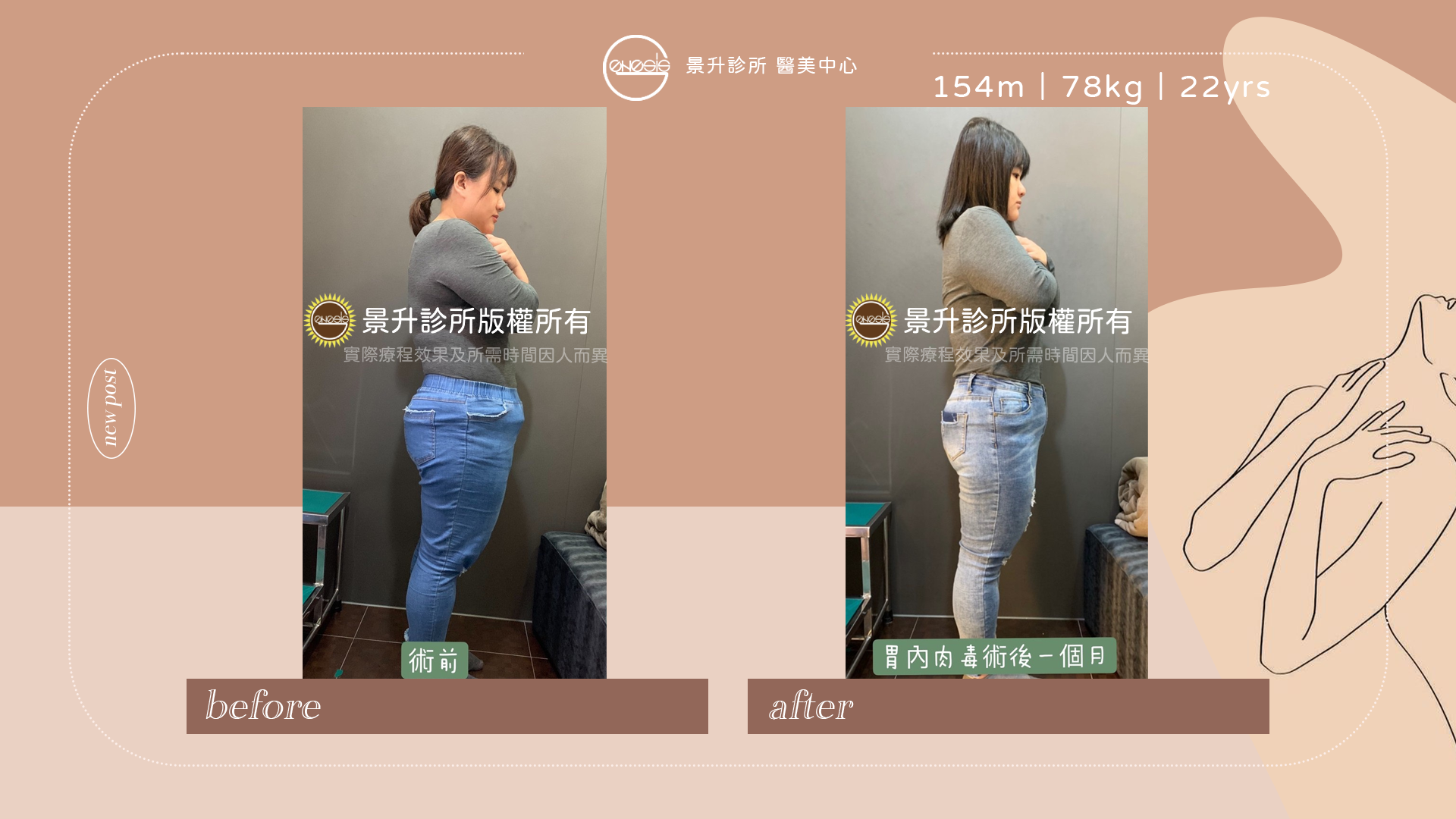 縮胃針(胃內肉毒桿菌注射)抑制食慾 - 景升診所 胃內肉毒素注射(俗稱縮胃針)讓減肥過程飲食控制更順利
