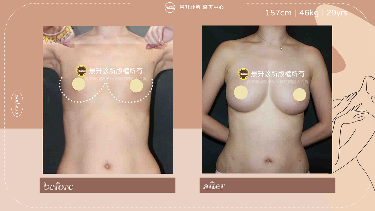 ▲自體脂肪隆乳亦可創造集中乳溝視覺效果