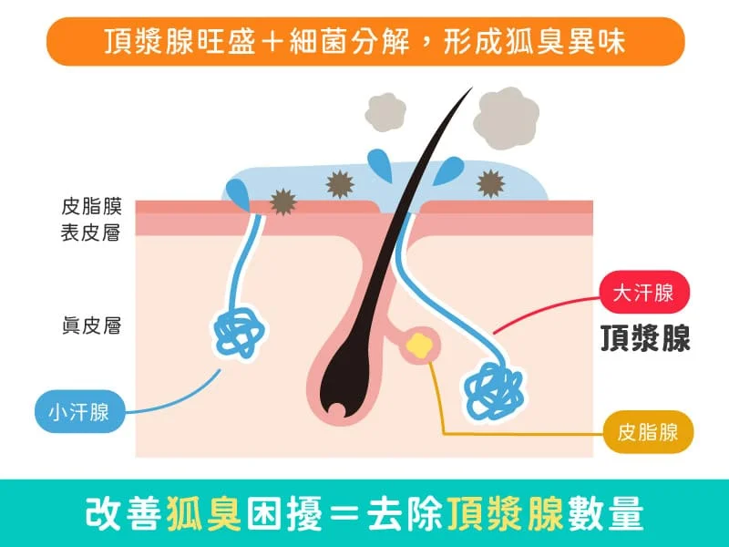 ▲改善狐臭困擾＝去除頂漿腺數量