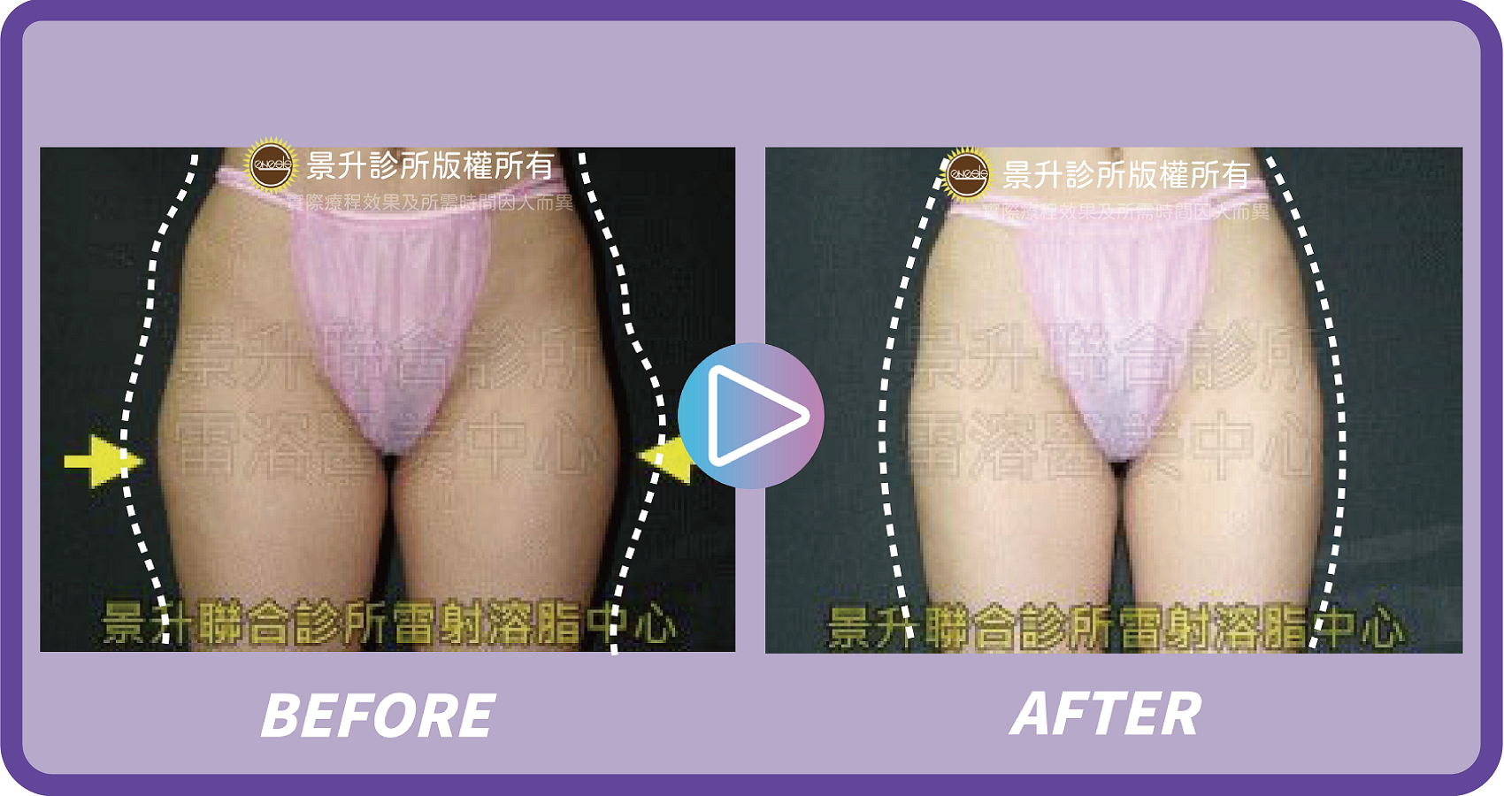 大腿抽脂改善什麼部位? - 景升診所 ▲ 大腿抽脂瘦大腿馬鞍肉,改善大腿外側線條